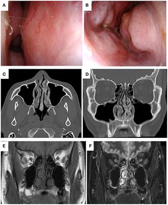 Localized Amyloidosis of the Nasal Mucosa: A Case Report and Review of the Literature